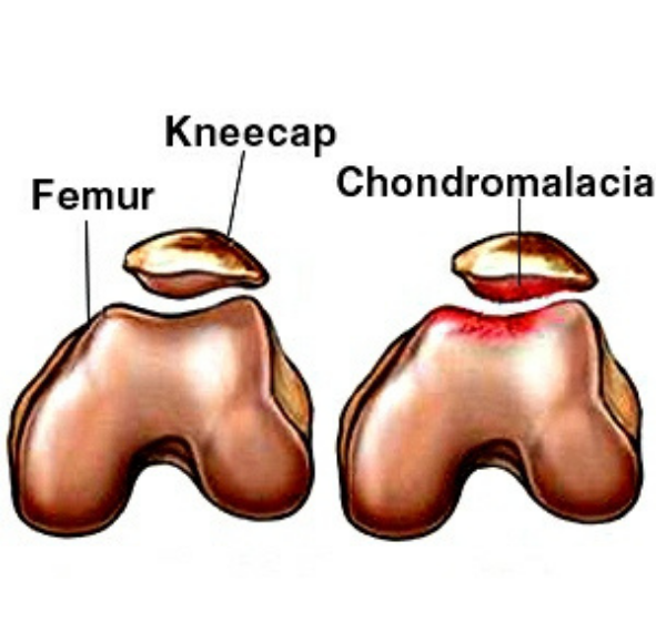 chondromalacja patella